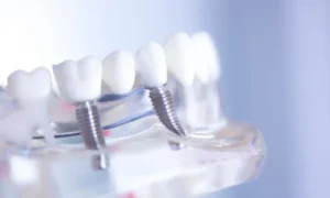 What's a Dental Bridge? (And Why You Need One) in Wayne, PA