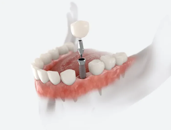 Dental Implants: The Real Timeline in Wayne, PA