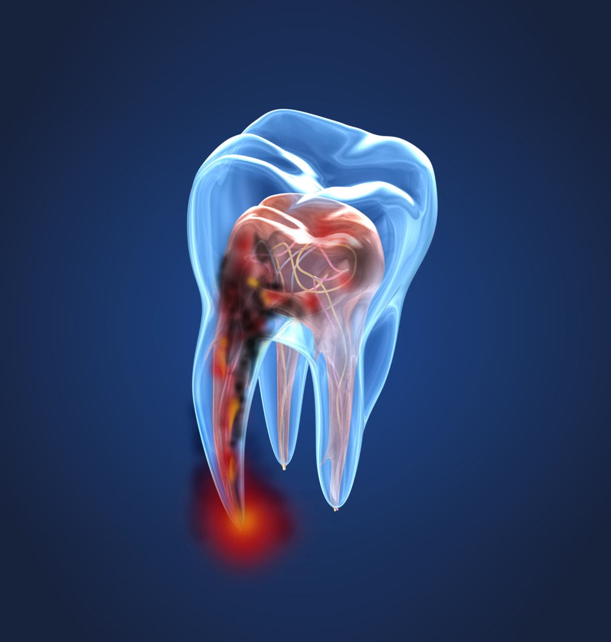 The Real Cost of Waiting on a Cavity